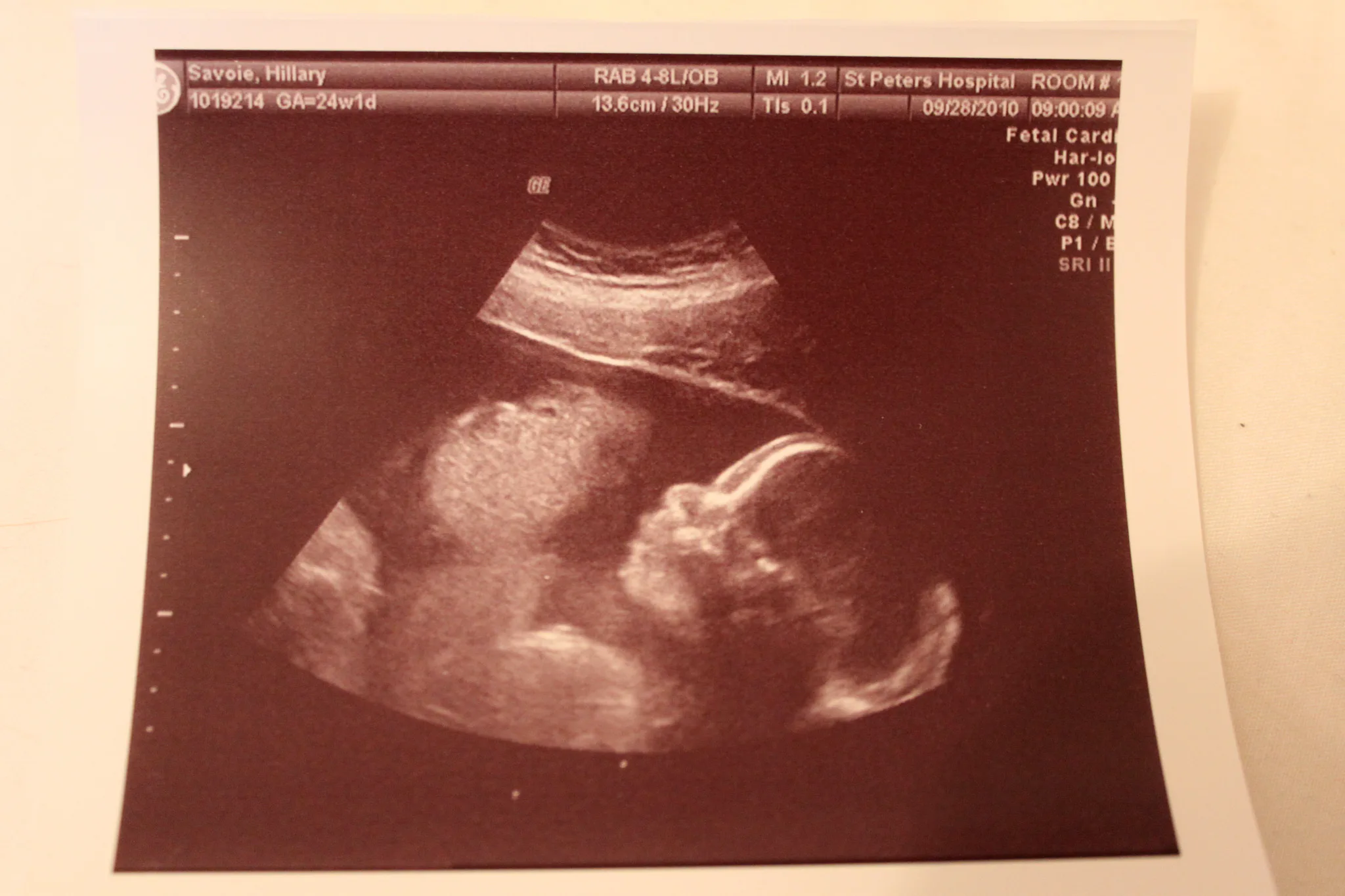 My 20 Week Ultrasound Raised Questions About My Baby s Future