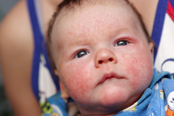 5 Signs Your Baby Is Allergic To Formula