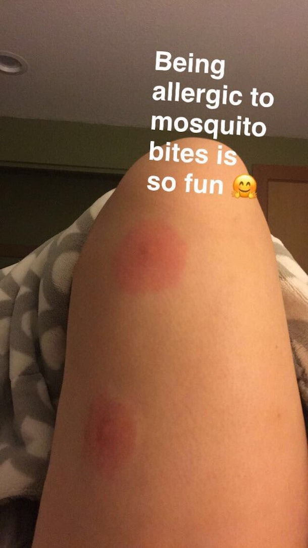 How To Tell If Youre Allergic To Mosquito Bites Because Skeeter 