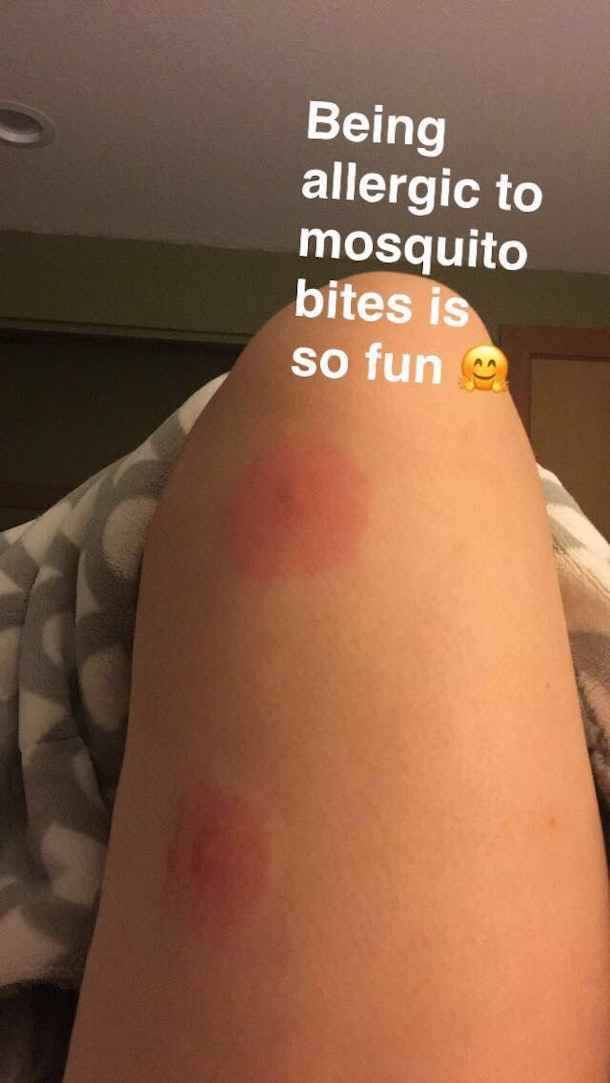 how-to-tell-if-you-re-allergic-to-mosquito-bites-because-skeeter