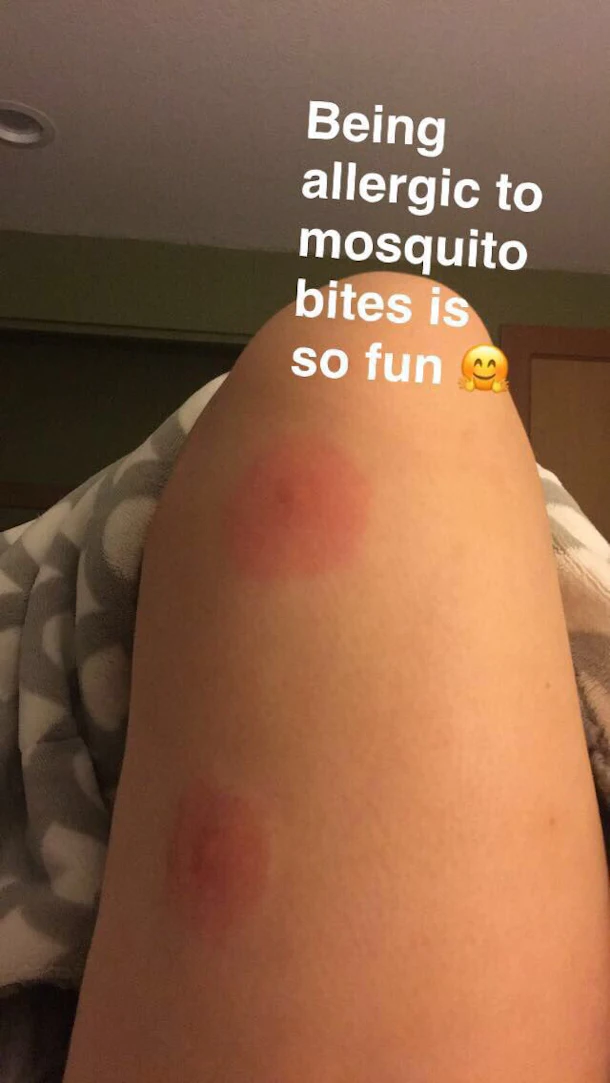 How To Tell If You re Allergic To Mosquito Bites Because Skeeter How to tell if you re allergic to mosquito bites because skeeter